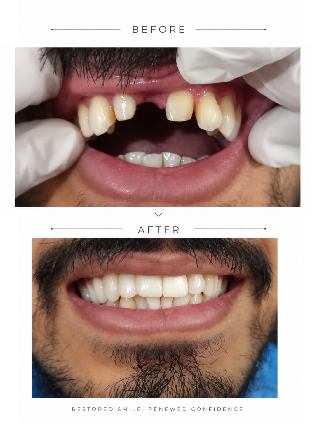 Before and after Crown and Bridges